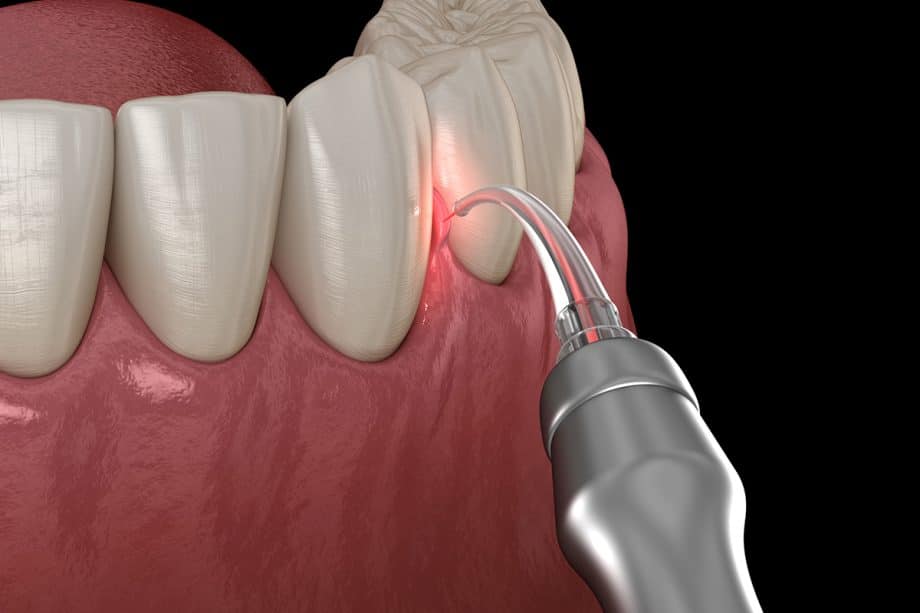 5 Signs Your Baby Might Benefit From a Laser Frenectomy