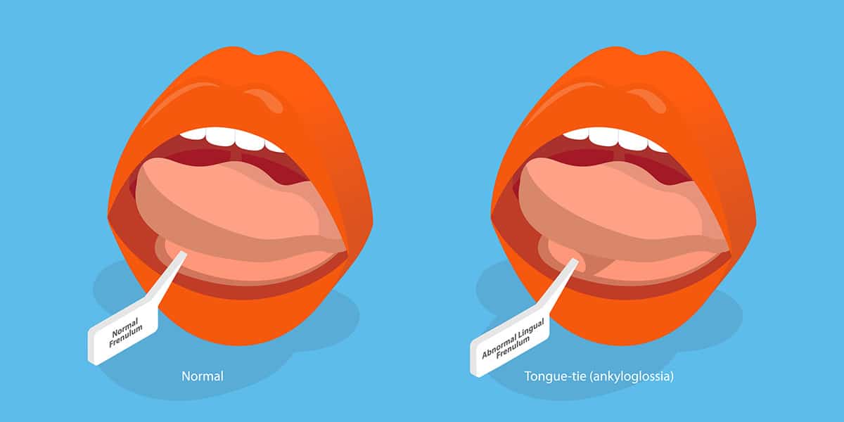 tongue tie release