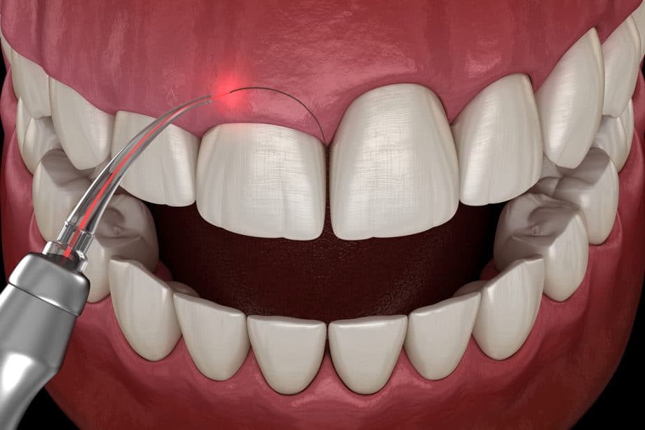 What are the benefits of laser vs surgical frenectomies?