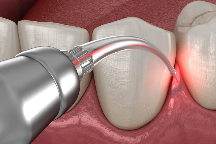 What to Expect After Your Child’s Laser Frenectomy in Gaithersburg, MD