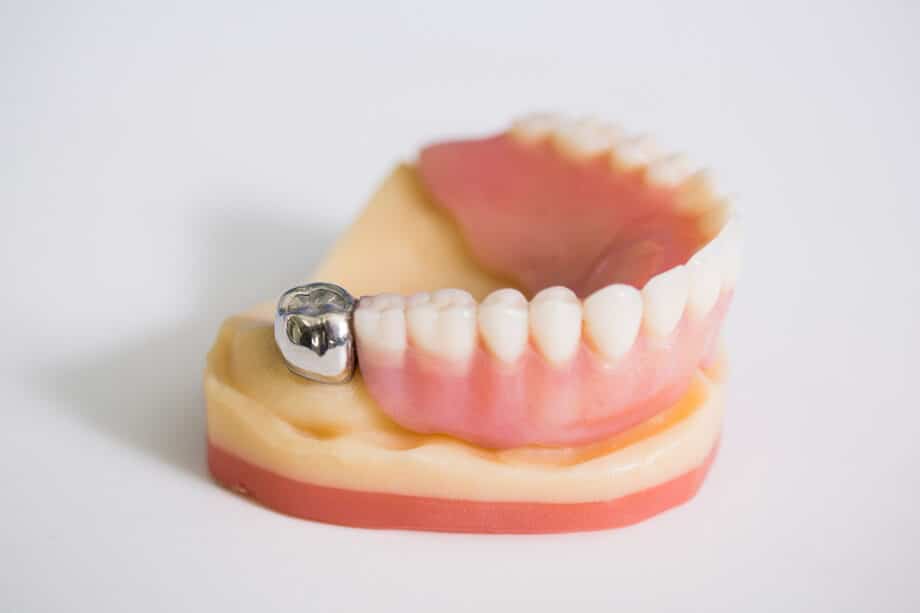When Is a Stainless Steel Crown Recommended for a Child's Tooth?